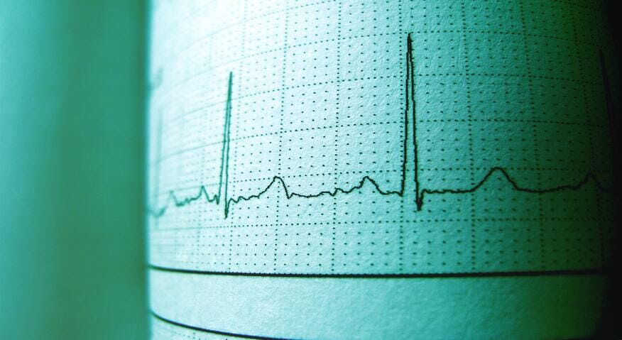 EKG Nedir?